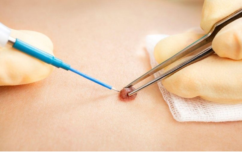 wart an d mole removal through spinach