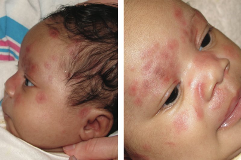 small chicken pox rashes on baby's face