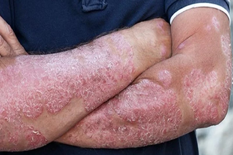 Psoriasis Treatment