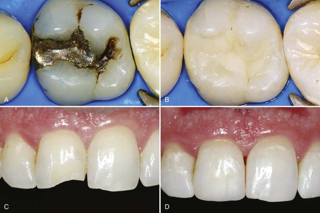 Dental Composite