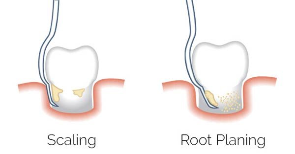Scaling Root planing
