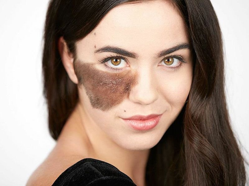 Birth Marks Removal