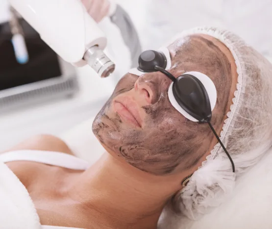 Carbon Laser Peel