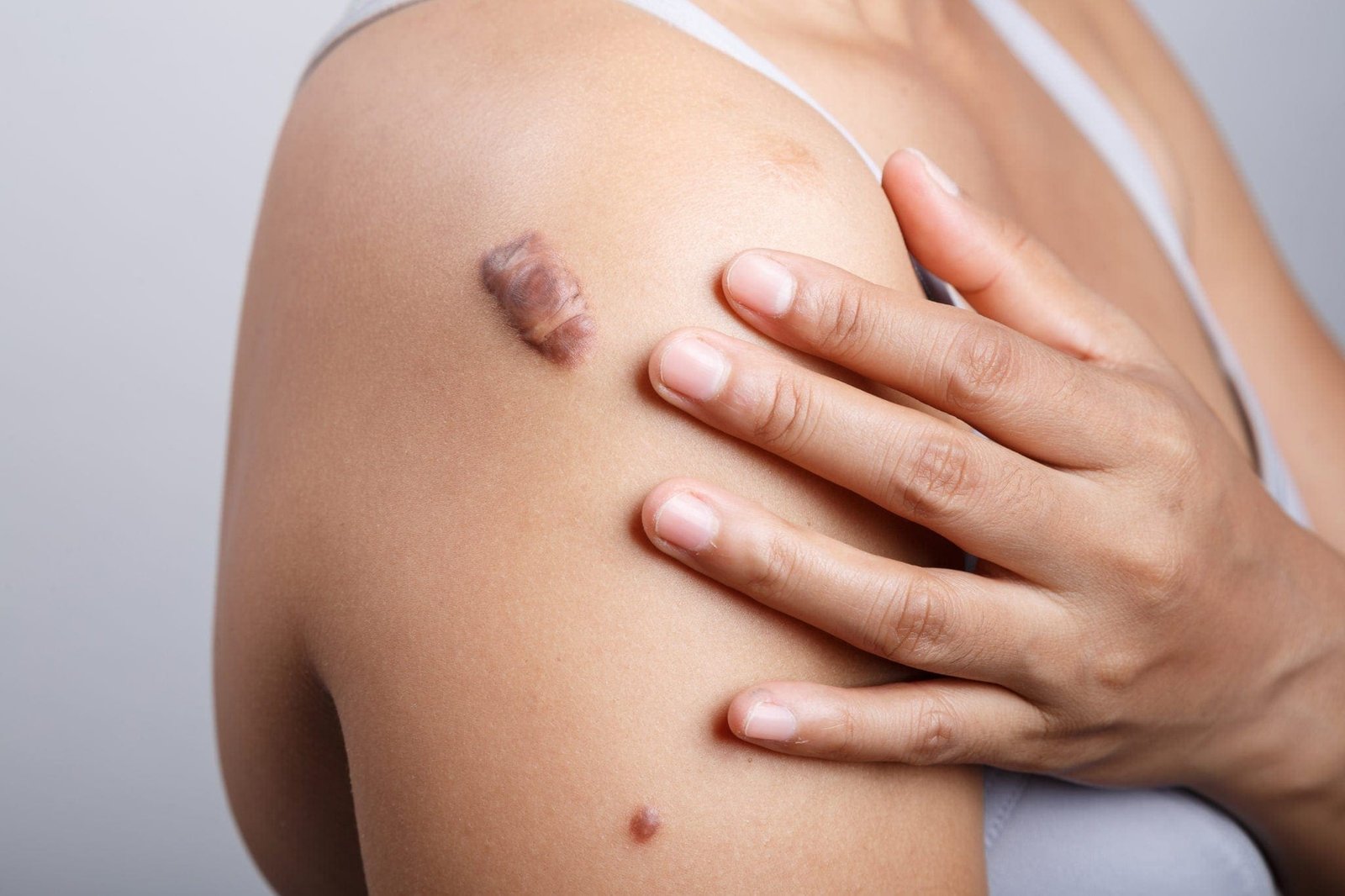 Keloid Treatment