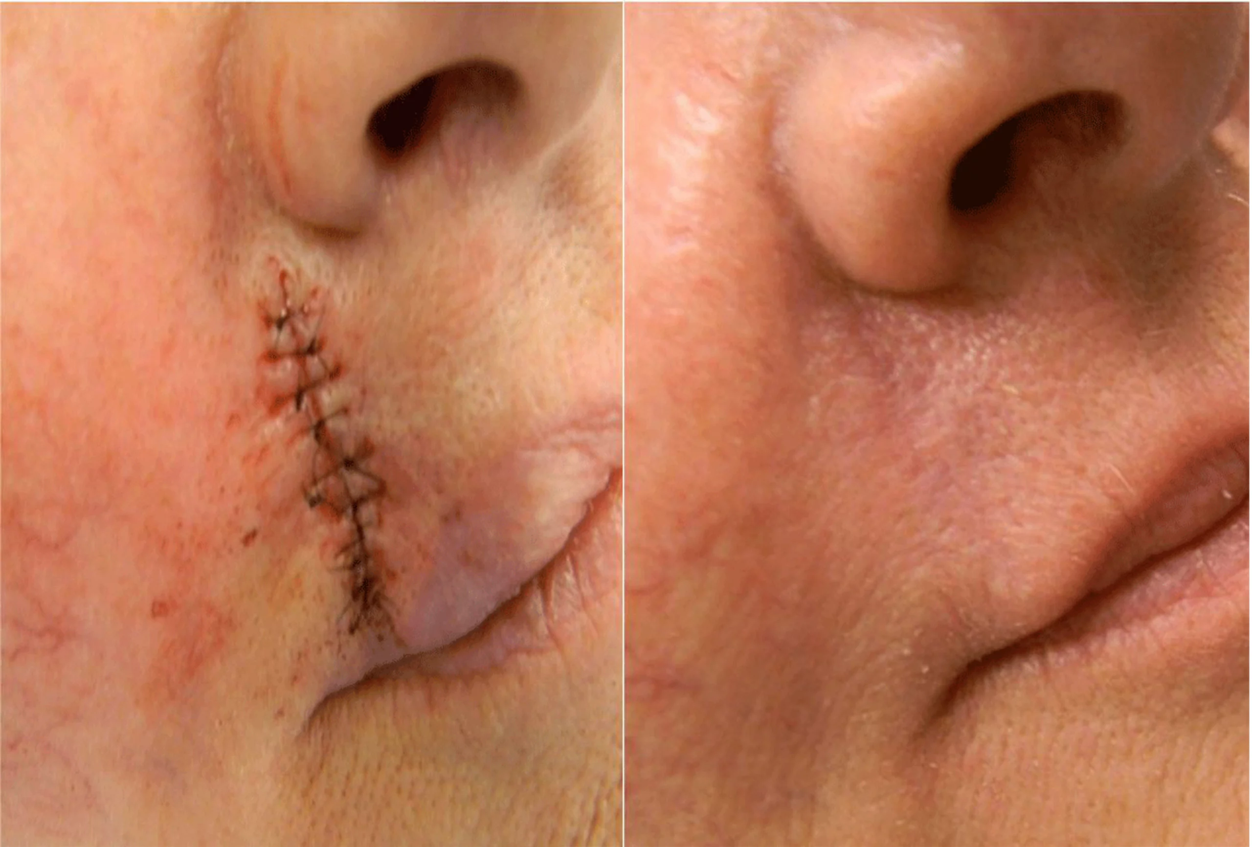 Scar Removal