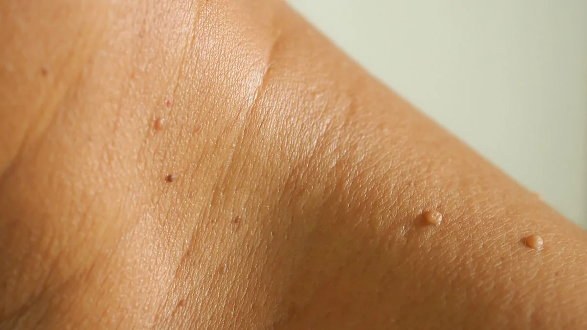 Wart & Skin Tags Removal