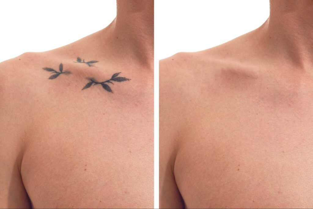 tattoo removal