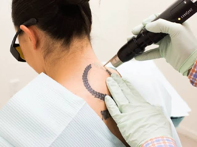 Tattoo Removal In Nagpur