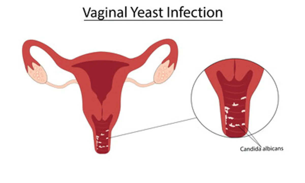 Vaginal Infection Treatment